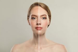 Koyu görünen cilde leke tedavisi yapılıyor